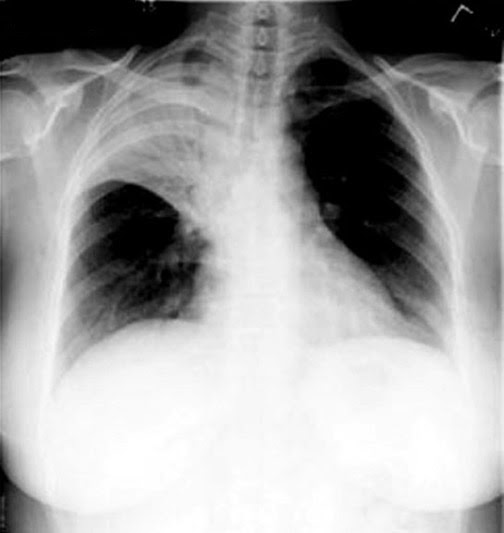 Chest x-ray of an adult patient with pneumonia. | Photo from Centers for Disease Control and Prevention